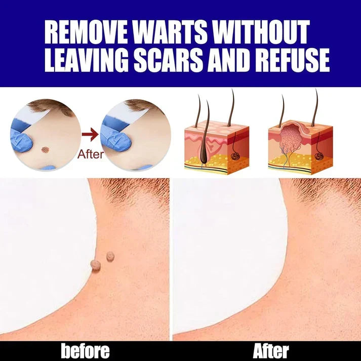 Wart Removal Gel